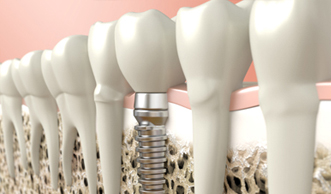 A mold of teeth showing how dental implants work.